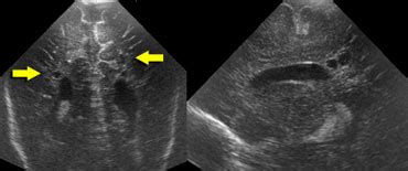 pvl meaning ultrasound