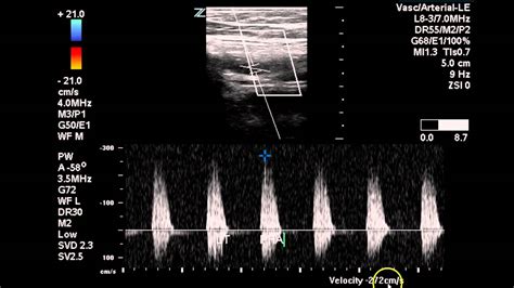 pvl ultrasound doppler