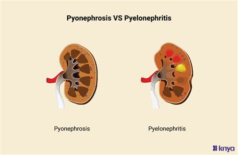 pyonephrosis vs pyelonephritis