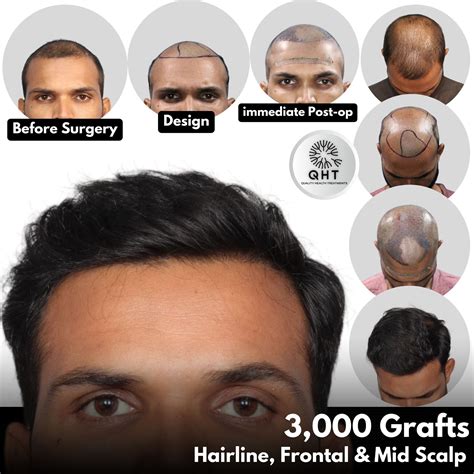 qht hair transplant hyderabad