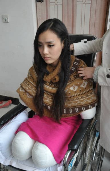 Intimate Explorations: Quad Amputee's Sexual Journey