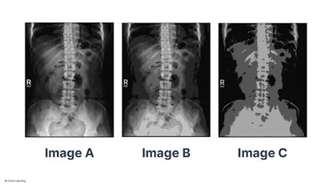 Quantization Radiology Quizlet
