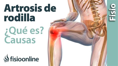 Salud Artrosis en la rodilla, un problema que agobia a los adultos