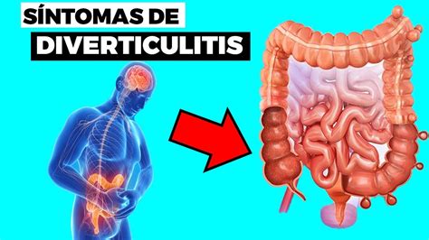 Understanding Que Es Diverticulitis: Causes, Symptoms, and Treatment Options