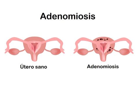 que es la adenomiosis