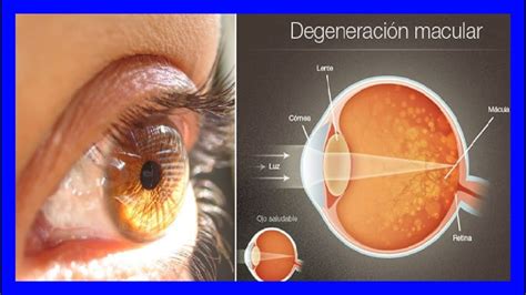 que es la degeneracion macular del ojo
