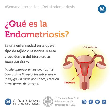 que es la endometriosis y que la causa