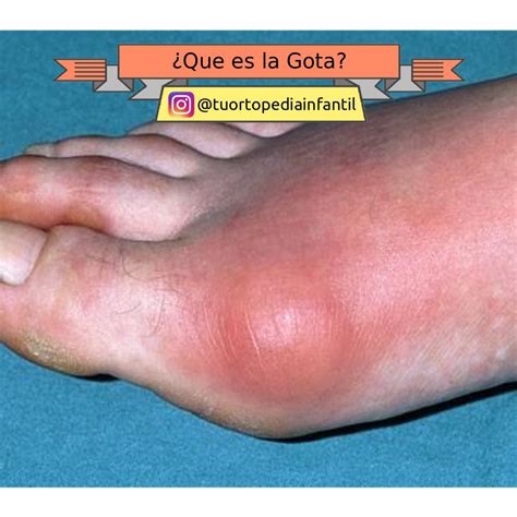 ¿Qué es la gota y cómo tratarla efectivamente?