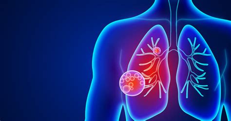 Que es la neumonia: síntomas, causas y tratamiento efectivo