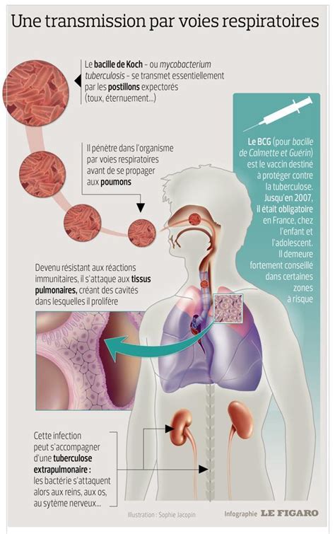 Tuberculosis stock vector. Illustration of bronchi, antibiotics 28061857