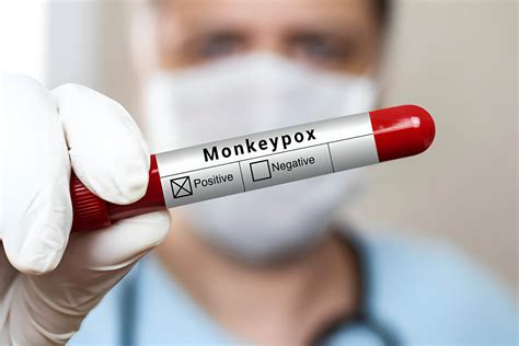 Quest Monkeypox Swabs