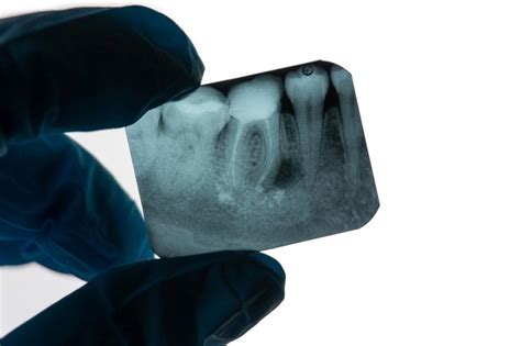 Questions To Ask Before Root Canal