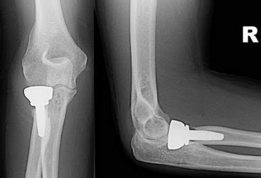 Radial Head Replacement Xray