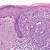 radicular cyst pathology outlines actinic keratosis