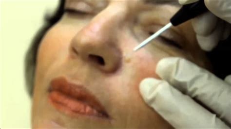 radio frequency mole removal or laser