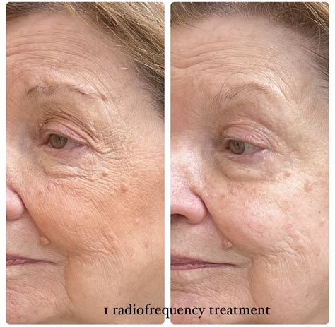 Achieve Your Glow Radio Frequency Face Before and After konmison Transform Your Skin Radio