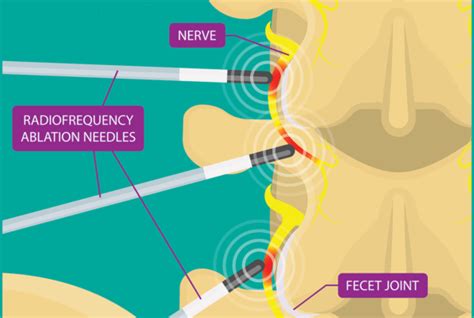 radiofrequency ablation for lower back pain