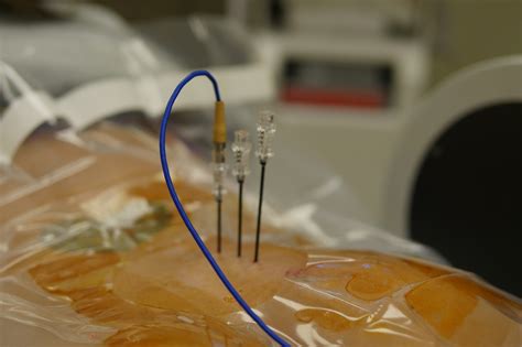 radiofrequency ablation pain management