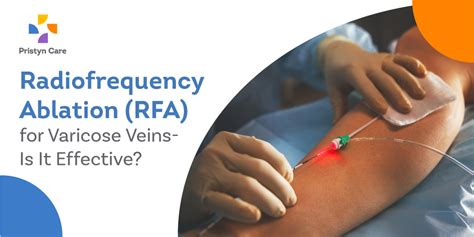 radiofrequency ablation procedure for veins
