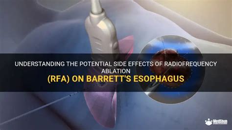 Understanding Radiofrequency Ablation Side Effects: A Comprehensive Guide