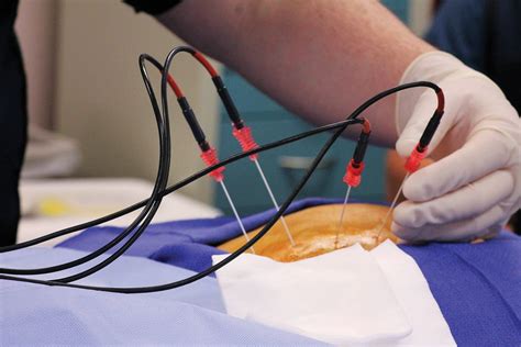 radiofrequency ablation video cervical spine