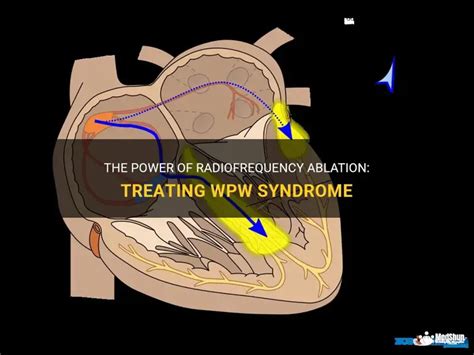 Radiofrequency Ablation Wpw