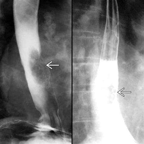 radiologic exam esophagus single contrast