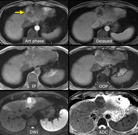 Radiology Assistant Hcc
