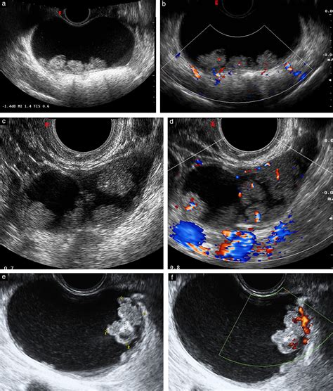 radiopaedia ovarian cyst