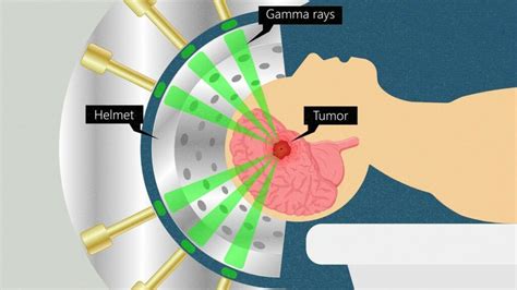 Radiosurgery Brain Tumor Side Effects