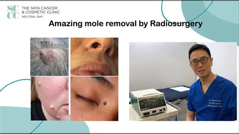 radiosurgery mole removal san jose