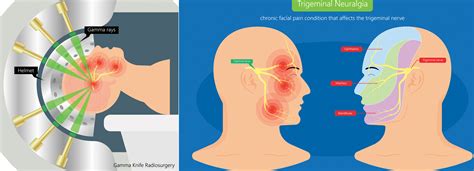 Radiosurgery Procedure Trigeminal Neuralgia