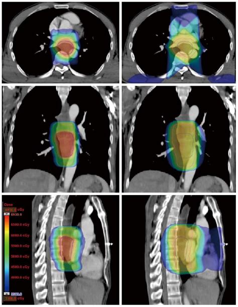 radiotherapy for esophageal cancer