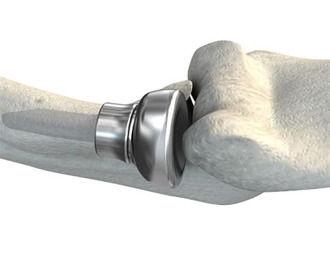 Radius Bone Replacement