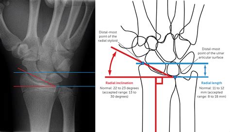 Radius Bone Too Long