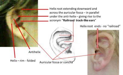 railroad track ears vs normal
