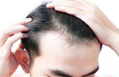 Rambut Rontok Normal Pria: Panduan Lengkap untuk Penyebab, Gejala, dan Pengobatan