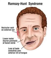 ramsay hunt syndrome icd 10