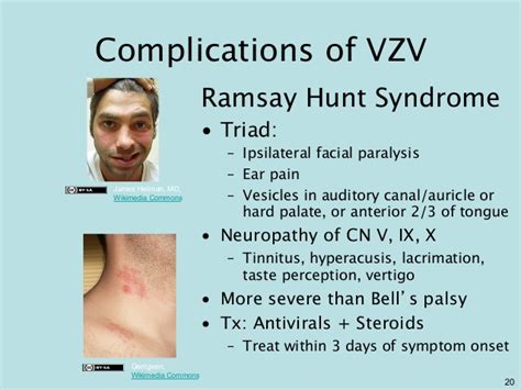 ramsay hunt syndrome treatment nhs