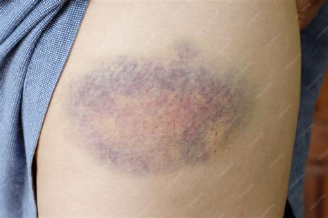 Unexplained Random Bruises on Body: Causes, Symptoms, and When to Seek Medical Attention
