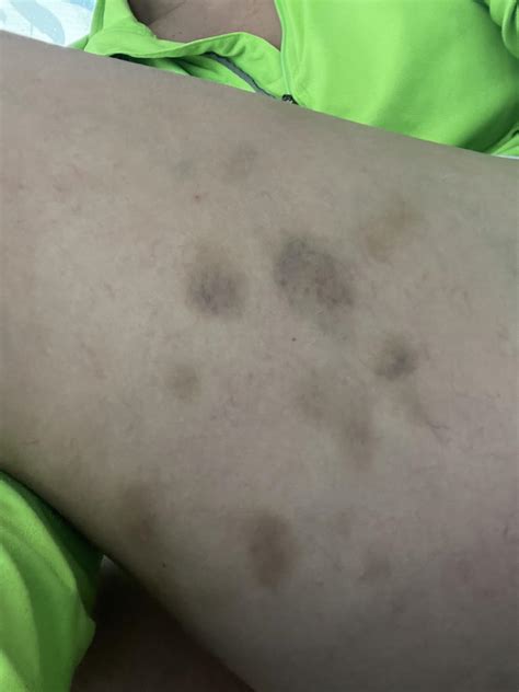 Understanding Random Bruises on Legs: Causes, Symptoms, and When to Seek Medical Attention