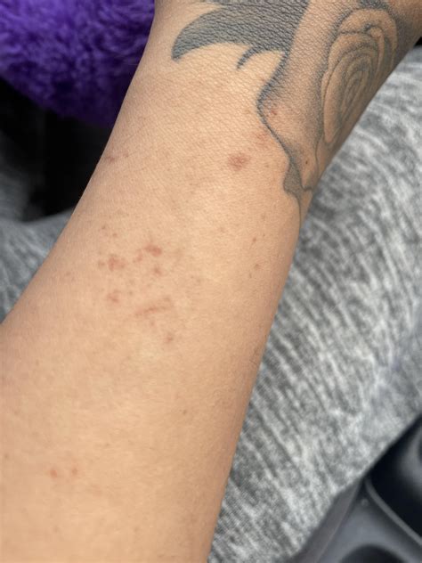 Random Dark Spots On Arm