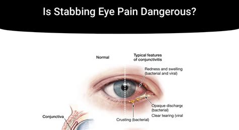 random stabbing pain in eye