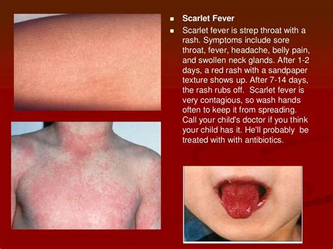 rash after fever breaks