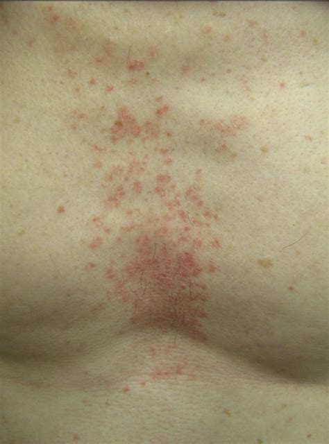 rash around chest and back