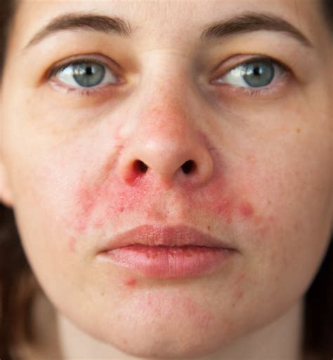 Red Rash Around Nose: Causes, Symptoms, and Effective Treatments