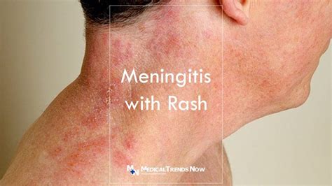 rash associated with meningitis