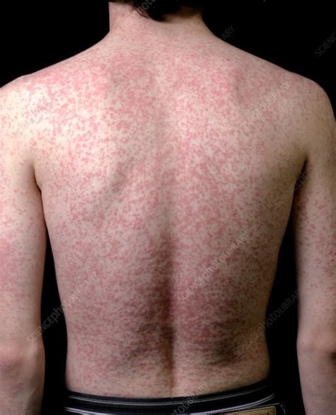 Antibiotics Side Effect: What Causes a Rash?