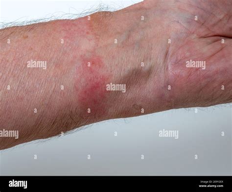 Rash From Leather