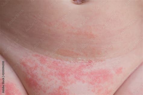 rash in babies leg rolls